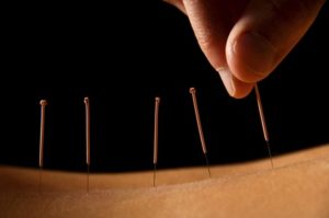 Acupuncture & Holistic Therapies